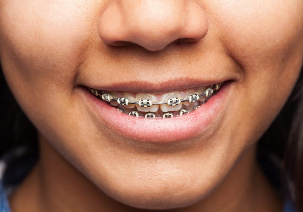 latin girl's mouth with brackets